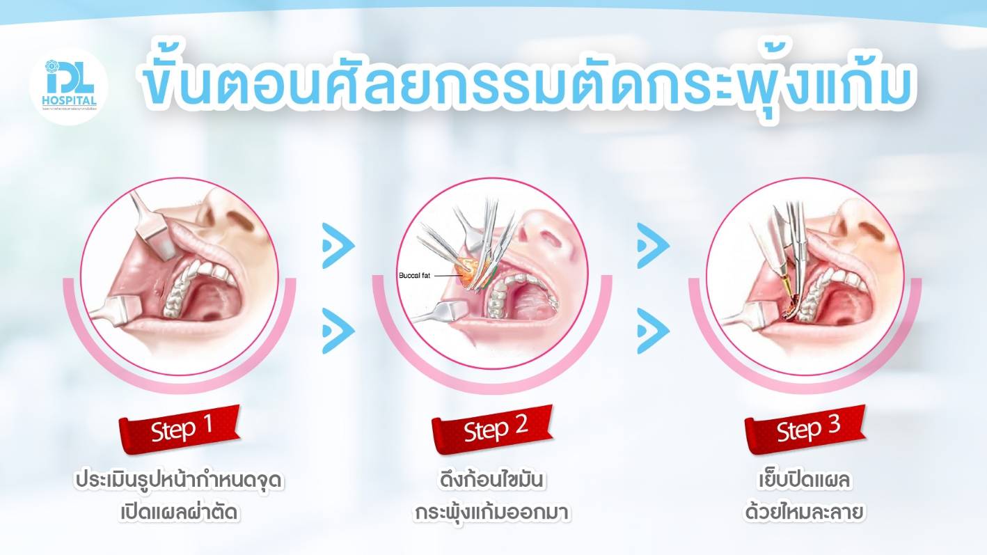 ตัดกระพุ้งแก้ม
