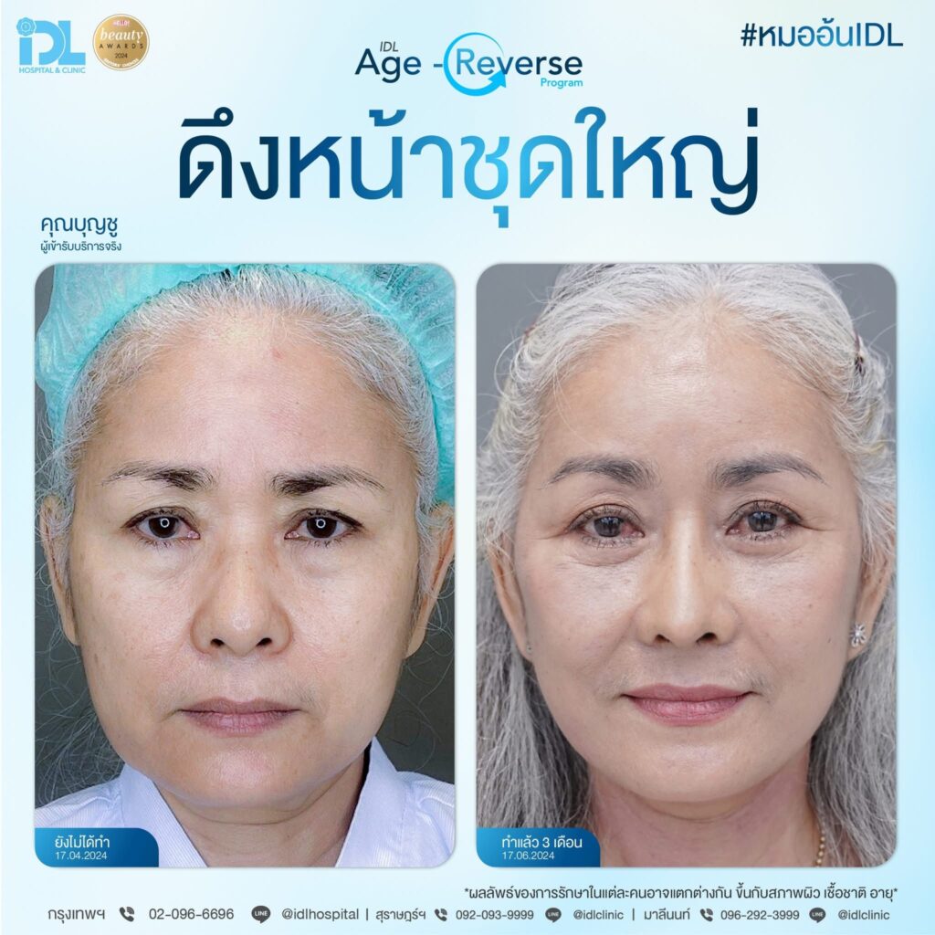 รีวิว ดึงหน้าชุดใหญ่