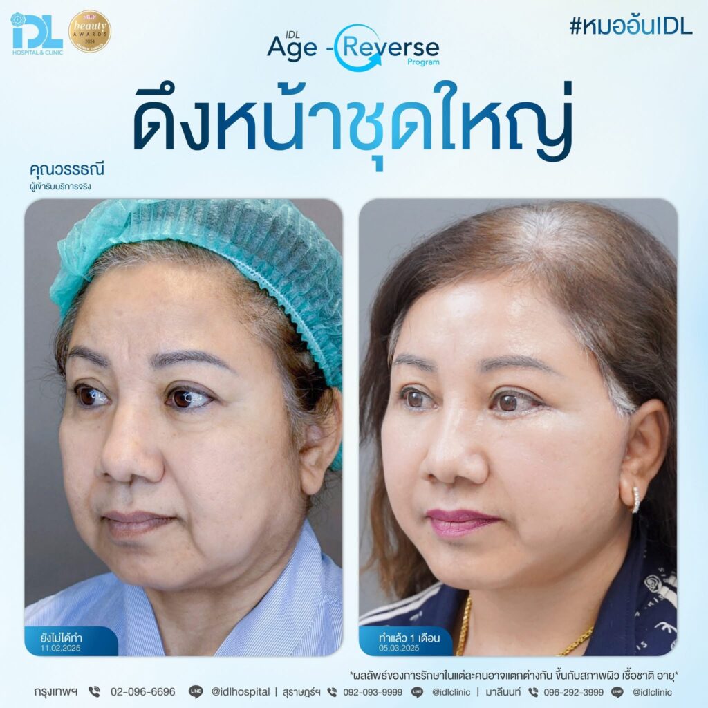 รีวิว ดึงหน้าชุดใหญ่