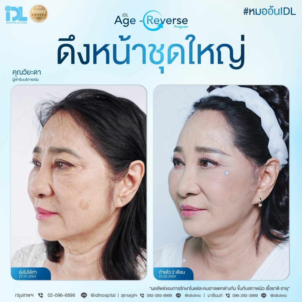 รีวิว ดึงหน้าชุดใหญ่