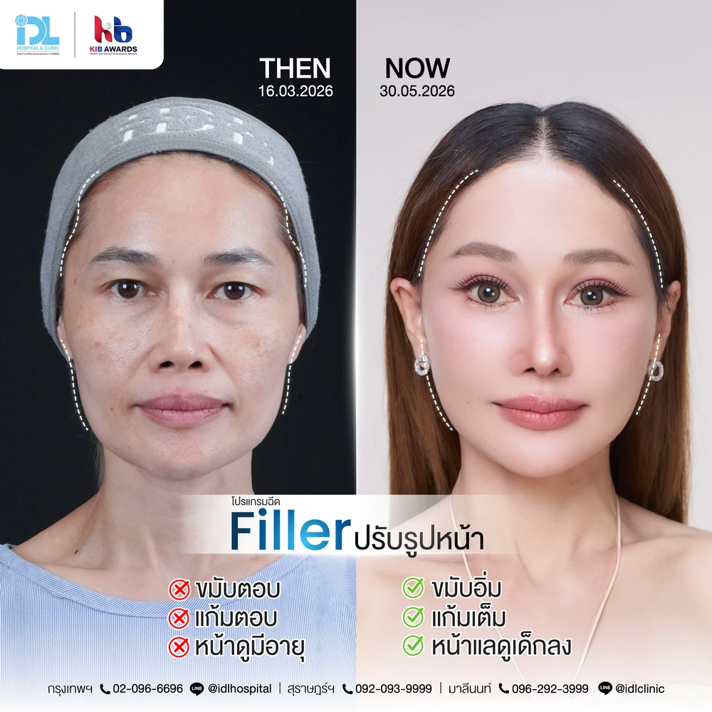 idl-surgery-wars-case01-ple-Filler-03