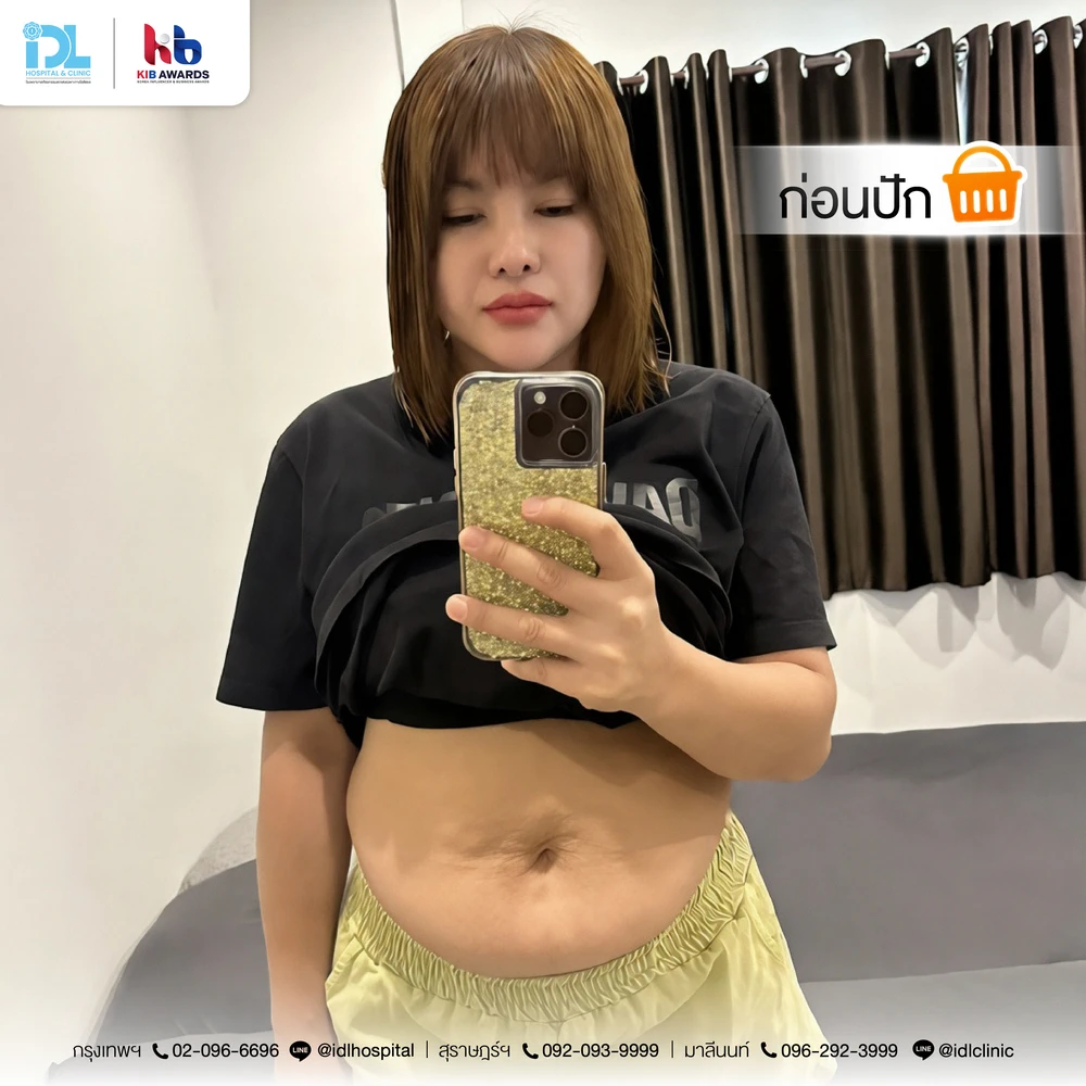 idl-surgery-wars-tummy-idl-body-reset (9)
